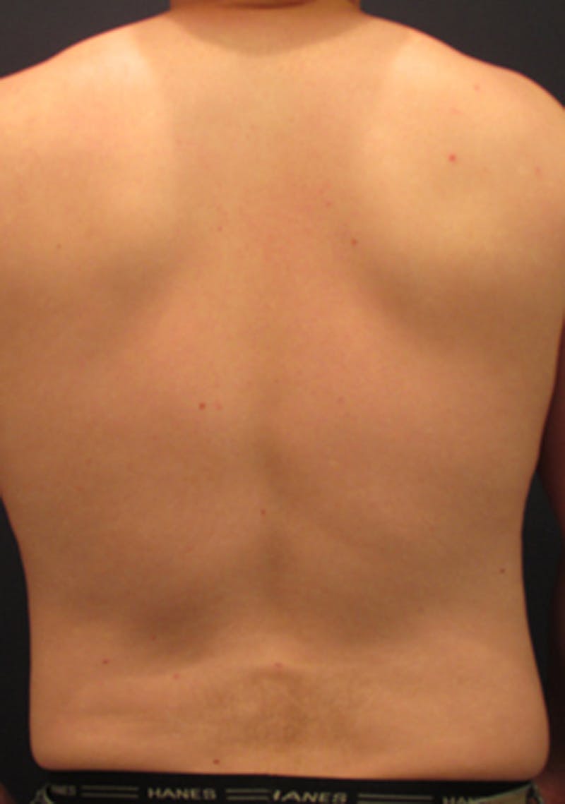 Liposuction Before & After Gallery - Patient 174163306 - Image 8