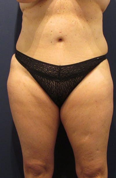 Liposuction Before & After Gallery - Patient 174163311 - Image 1