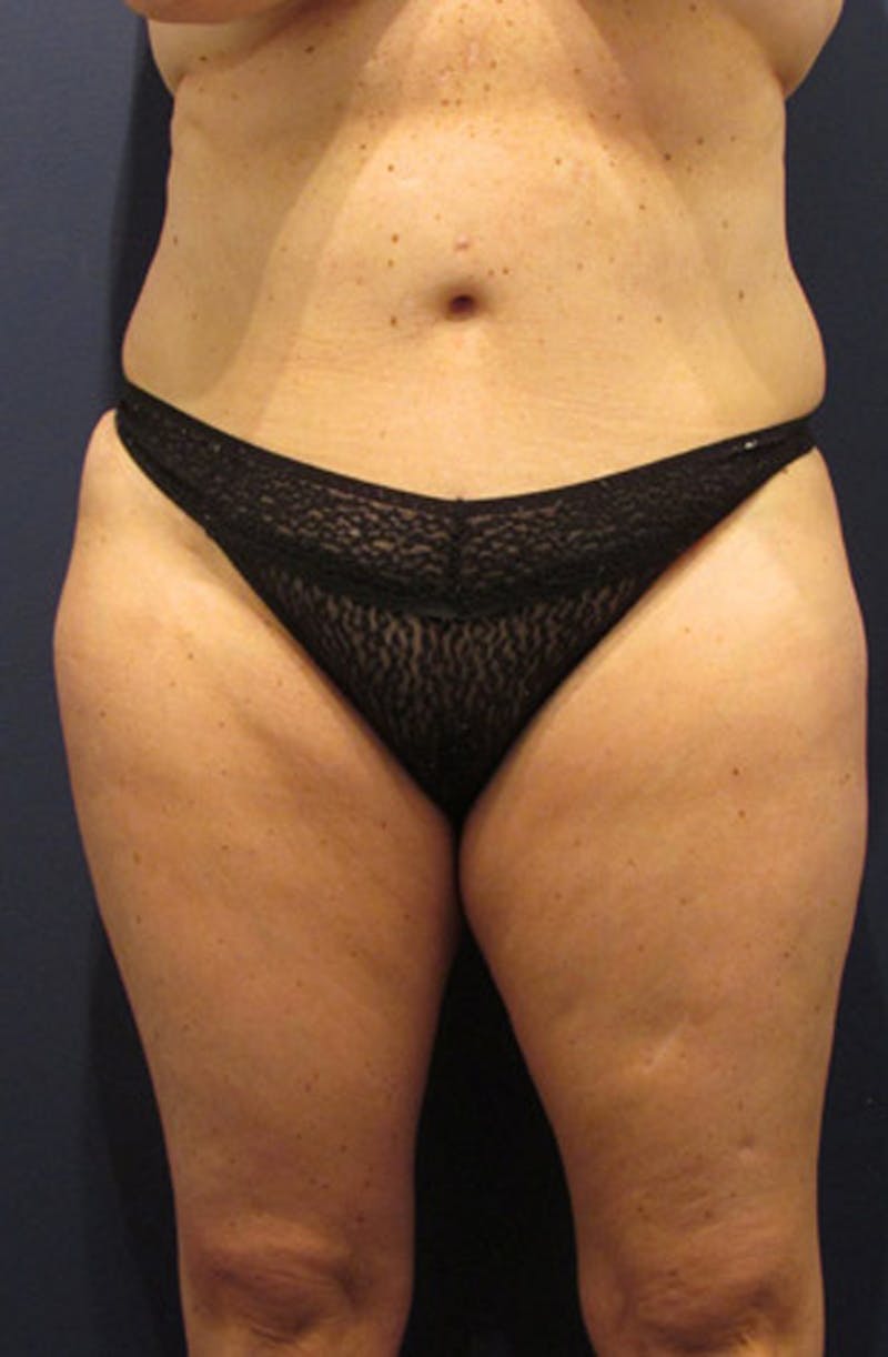 Liposuction Before & After Gallery - Patient 174163311 - Image 1