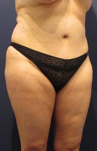 Liposuction Before & After Gallery - Patient 174163311 - Image 2