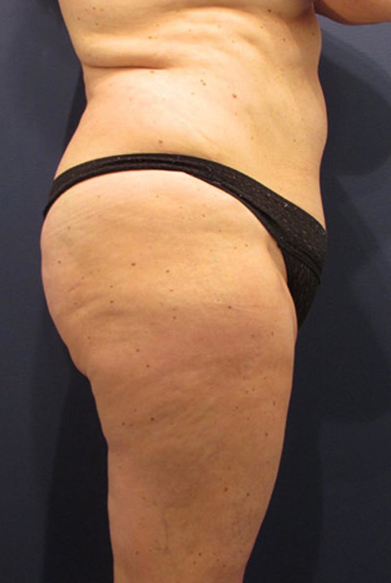 Liposuction Before & After Gallery - Patient 174163311 - Image 3