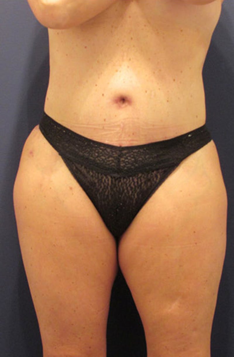 Liposuction Before & After Gallery - Patient 174163311 - Image 4