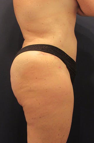 Liposuction Before & After Gallery - Patient 174163311 - Image 6