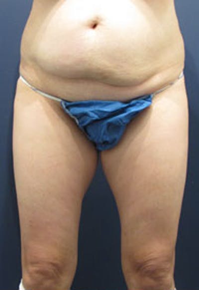 Liposuction Before & After Gallery - Patient 174163318 - Image 1