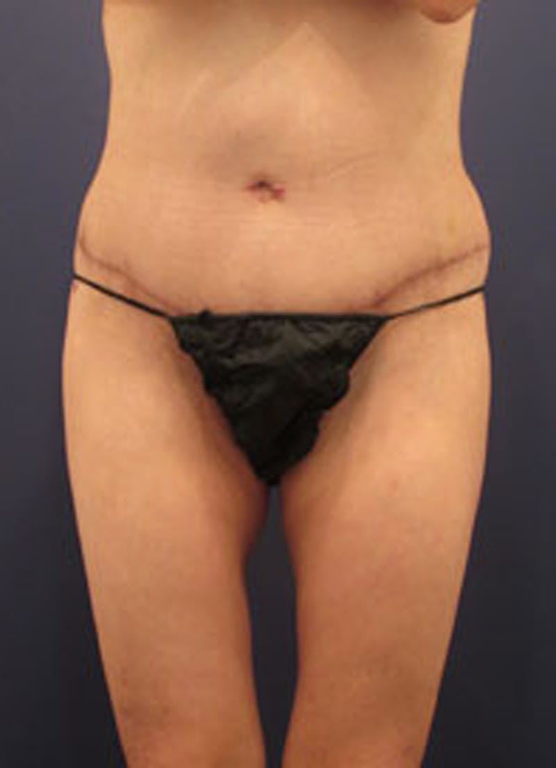 Liposuction Before & After Gallery - Patient 174163318 - Image 2