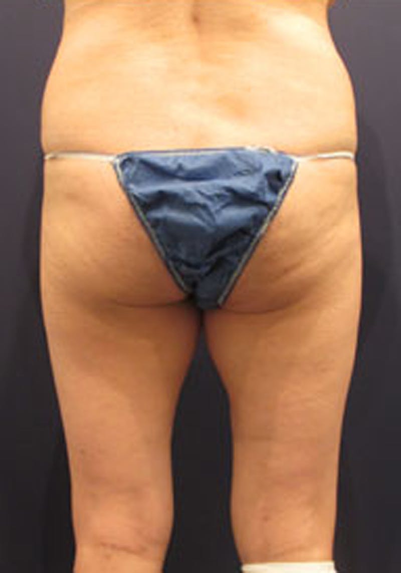 Liposuction Before & After Gallery - Patient 174163318 - Image 3