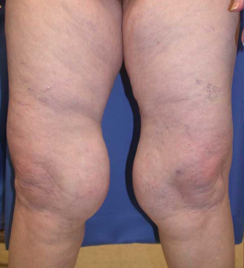 Liposuction Before & After Gallery - Patient 174164395 - Image 1