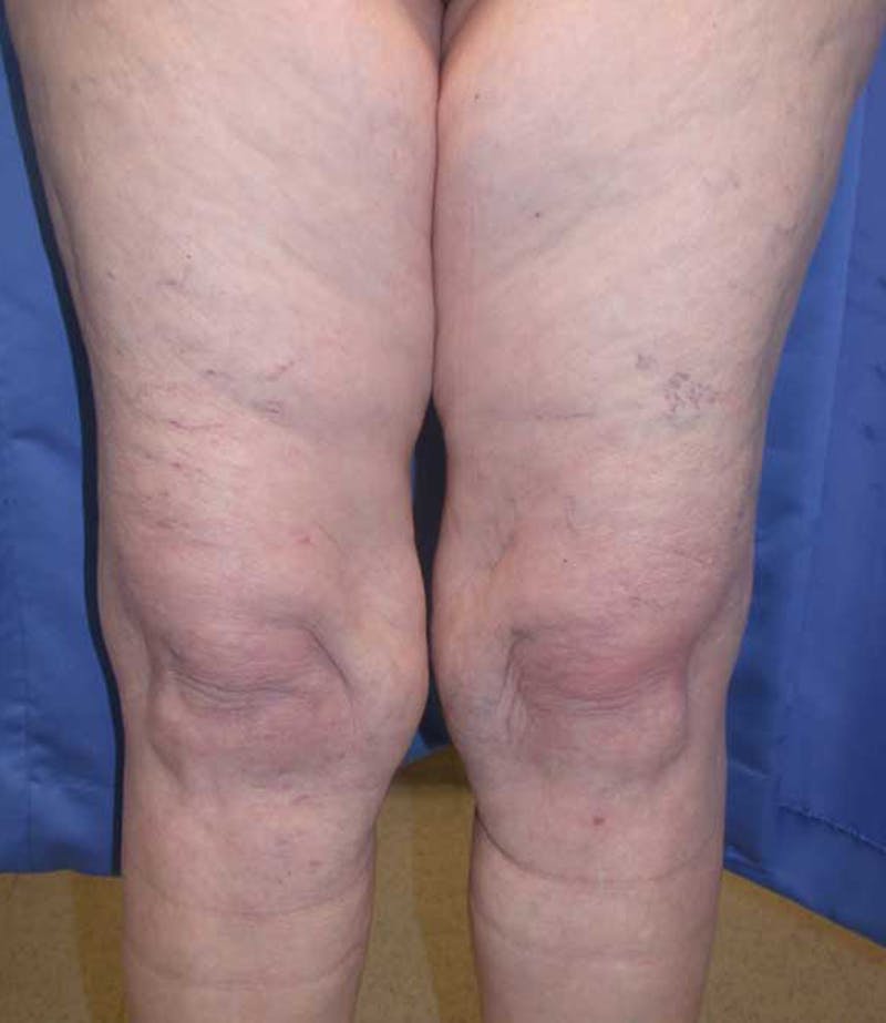 Liposuction Before & After Gallery - Patient 174164395 - Image 2
