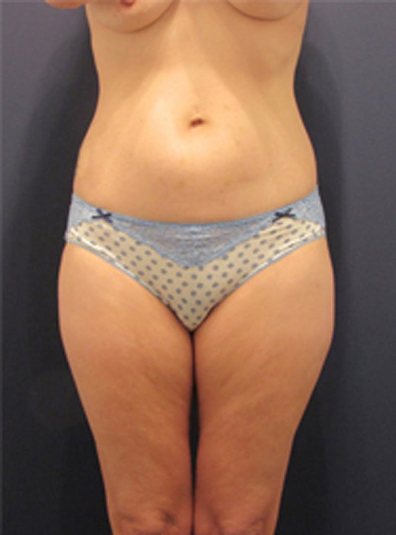 Liposuction Before & After Gallery - Patient 174164403 - Image 1