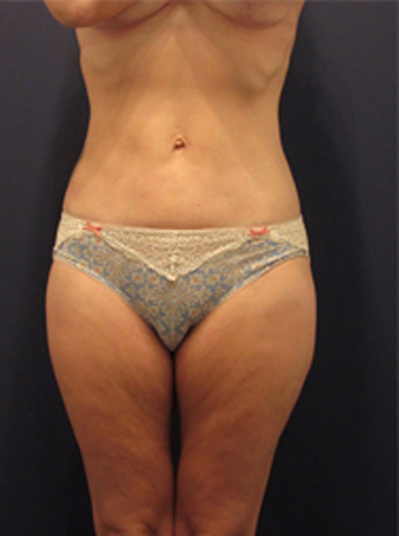 Liposuction Before & After Gallery - Patient 174164403 - Image 2