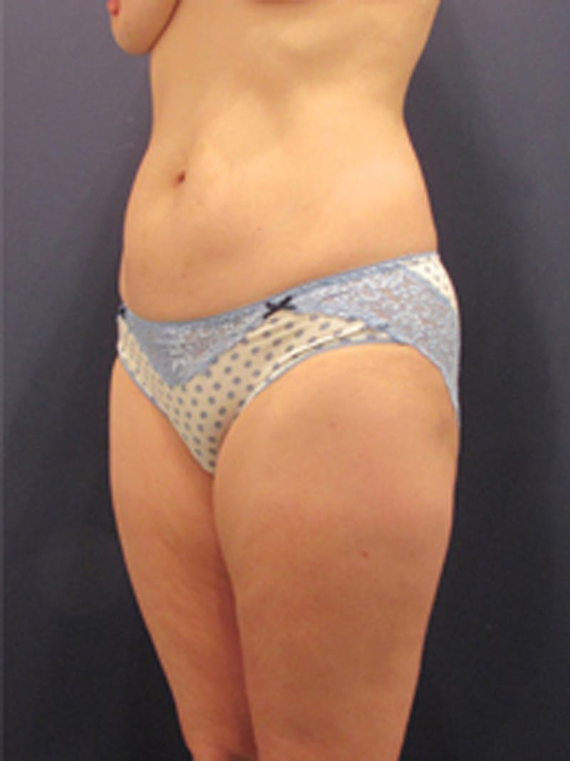 Liposuction Before & After Gallery - Patient 174164403 - Image 3