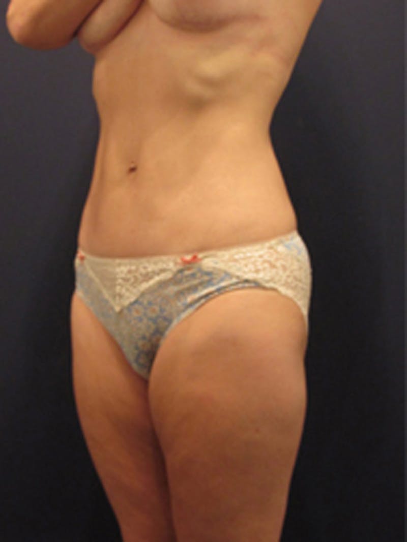 Liposuction Before & After Gallery - Patient 174164403 - Image 4