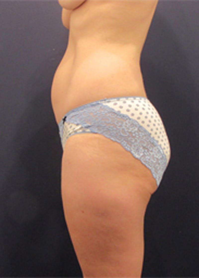 Liposuction Before & After Gallery - Patient 174164403 - Image 5