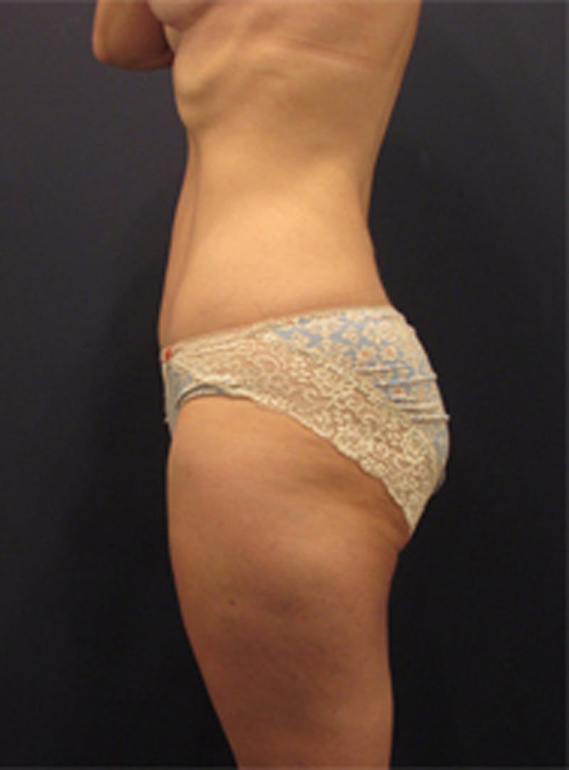 Liposuction Before & After Gallery - Patient 174164403 - Image 6