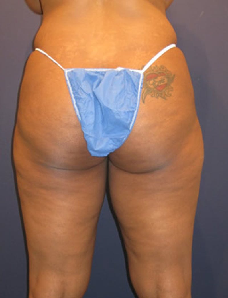 Liposuction Before & After Gallery - Patient 174164408 - Image 1