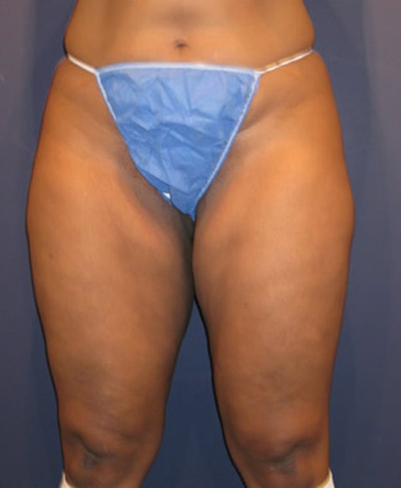 Liposuction Before & After Gallery - Patient 174164408 - Image 3
