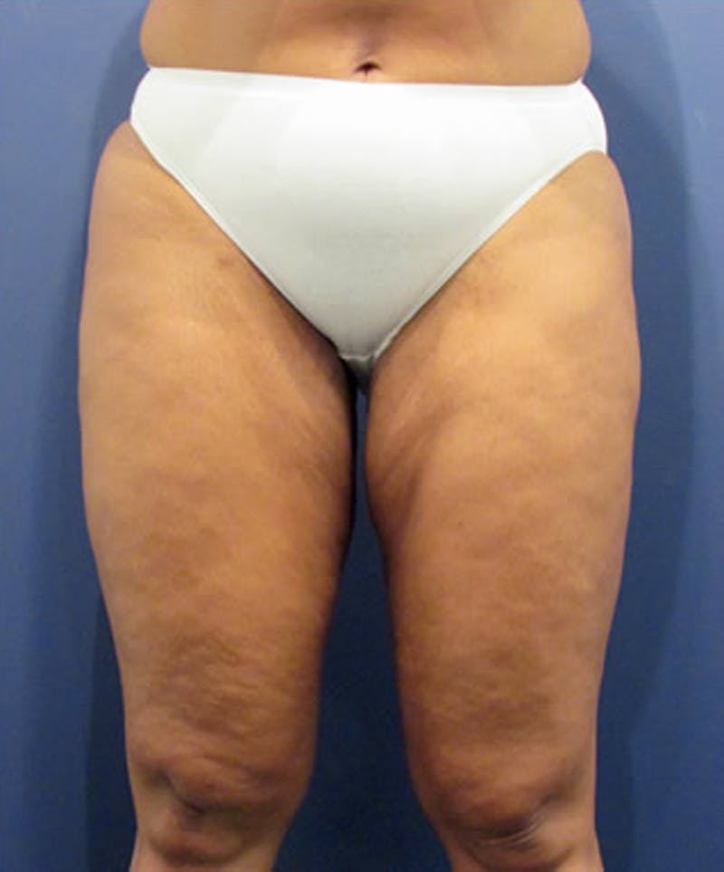 Liposuction Before & After Gallery - Patient 174164408 - Image 4