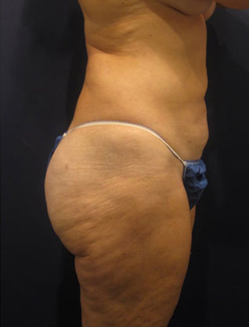 Liposuction Before & After Gallery - Patient 174164416 - Image 6