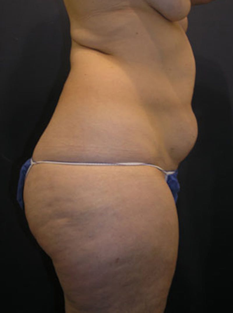 Liposuction Before & After Gallery - Patient 174164416 - Image 5