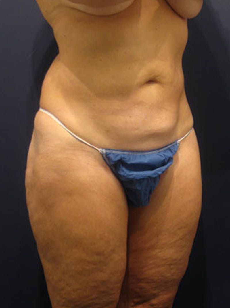 Liposuction Before & After Gallery - Patient 174164416 - Image 4