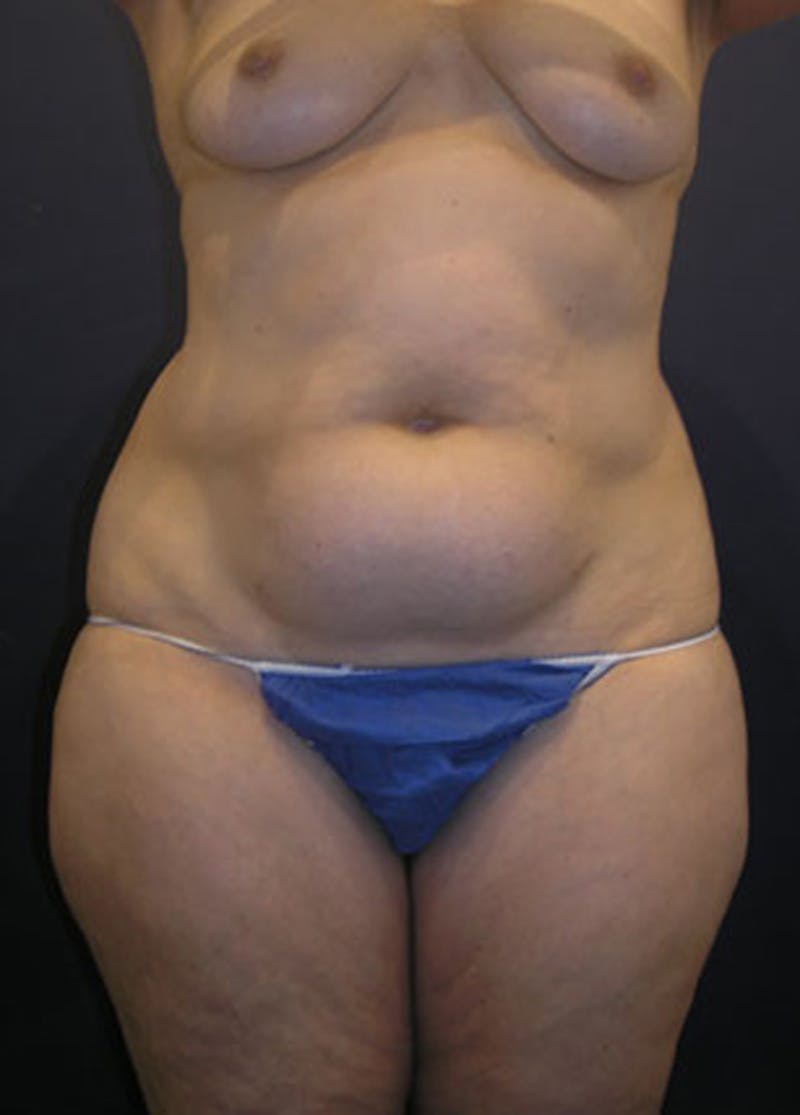 Liposuction Before & After Gallery - Patient 174164416 - Image 1