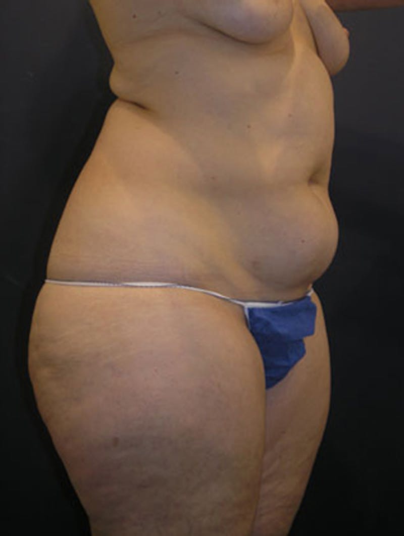 Liposuction Before & After Gallery - Patient 174164416 - Image 3
