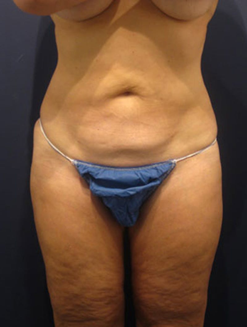 Liposuction Before & After Gallery - Patient 174164416 - Image 2
