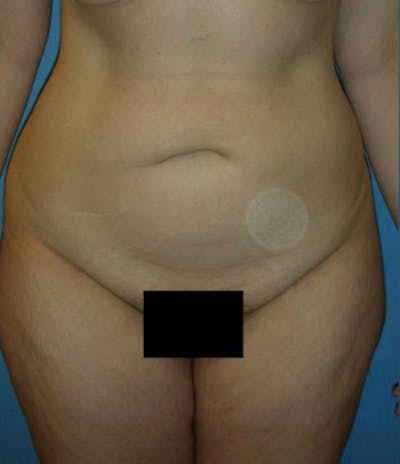 Liposuction Before & After Gallery - Patient 174164421 - Image 1