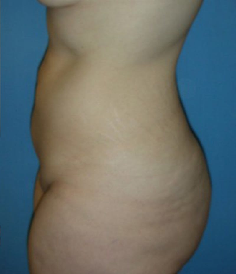 Liposuction Before & After Gallery - Patient 174164421 - Image 3