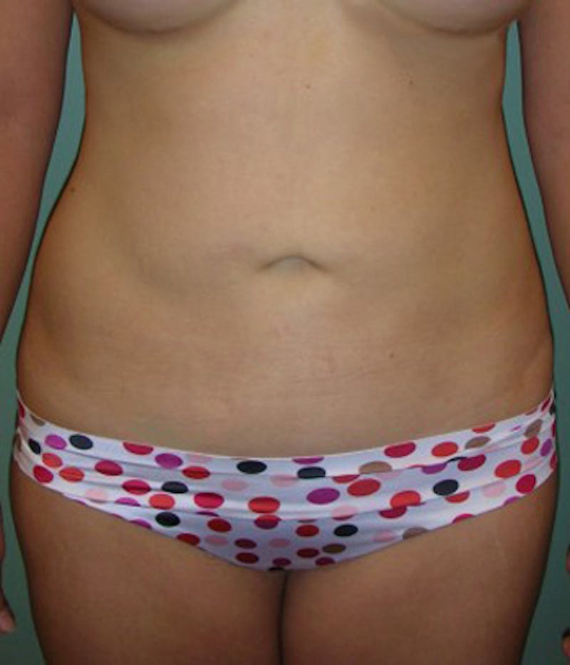 Liposuction Before & After Gallery - Patient 174164421 - Image 2