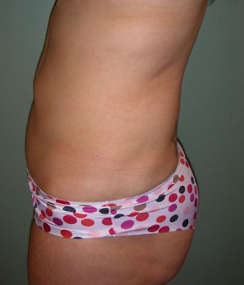 Liposuction Before & After Gallery - Patient 174164421 - Image 4