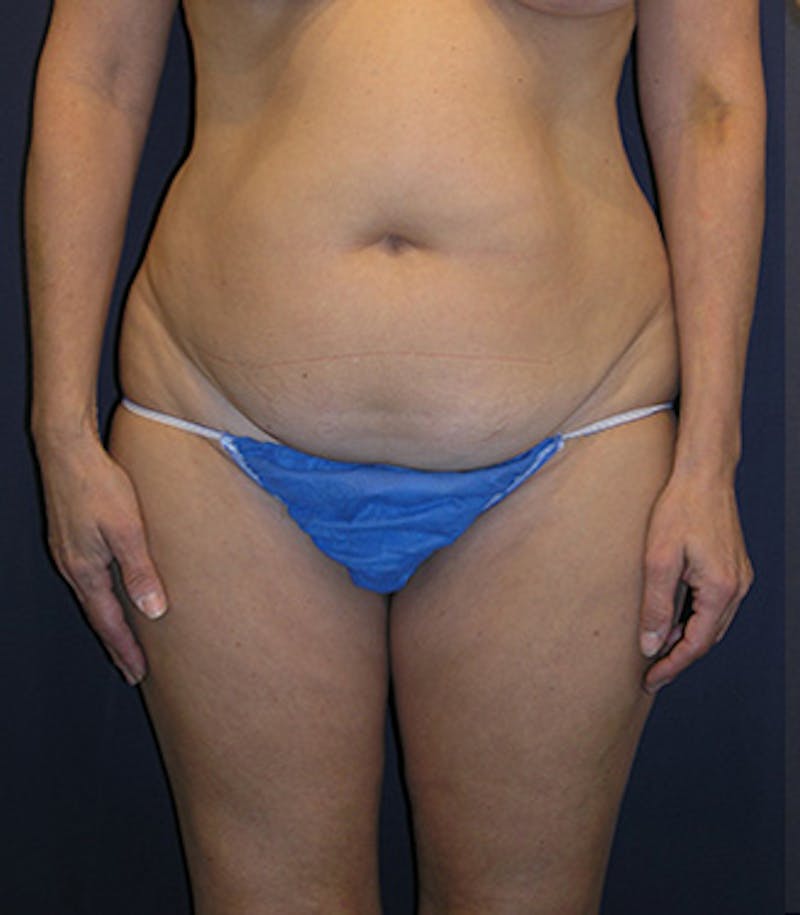 Liposuction Before & After Gallery - Patient 174164425 - Image 1
