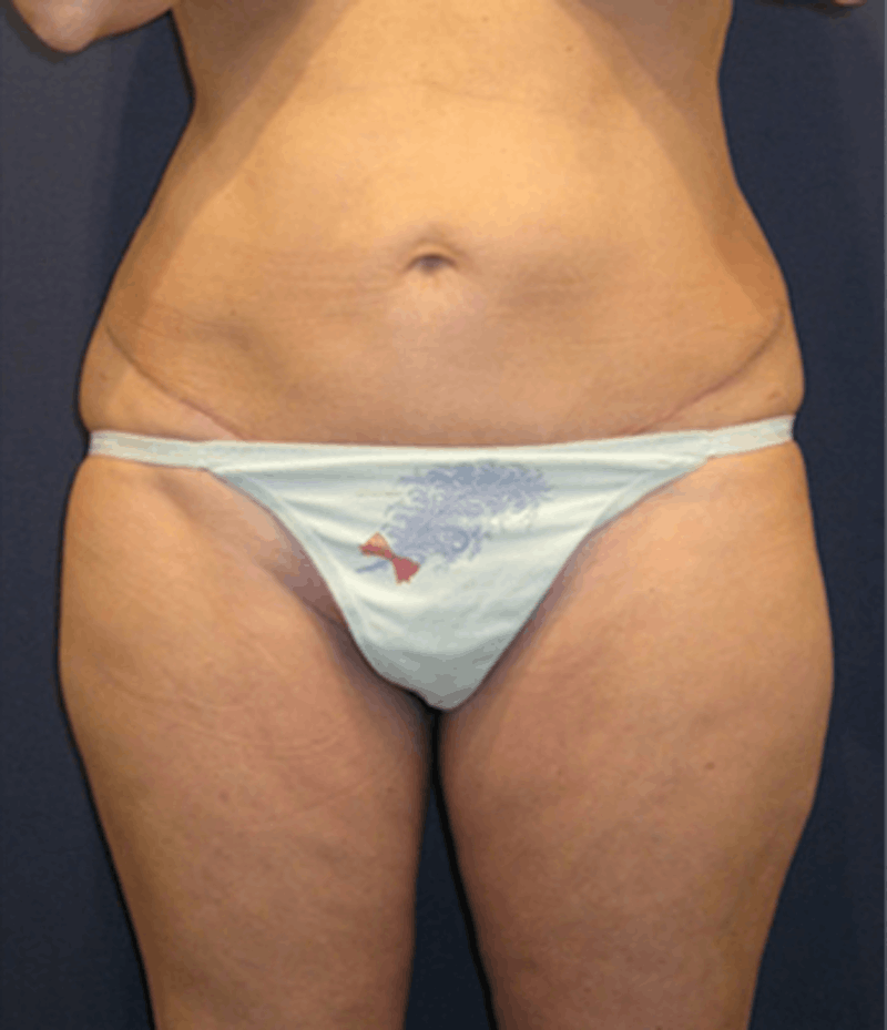 Liposuction Before & After Gallery - Patient 174164425 - Image 2