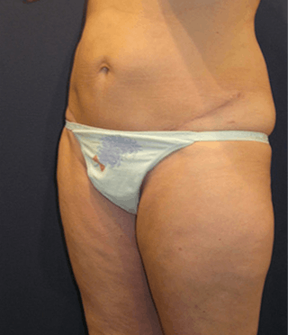 Liposuction Before & After Gallery - Patient 174164425 - Image 4