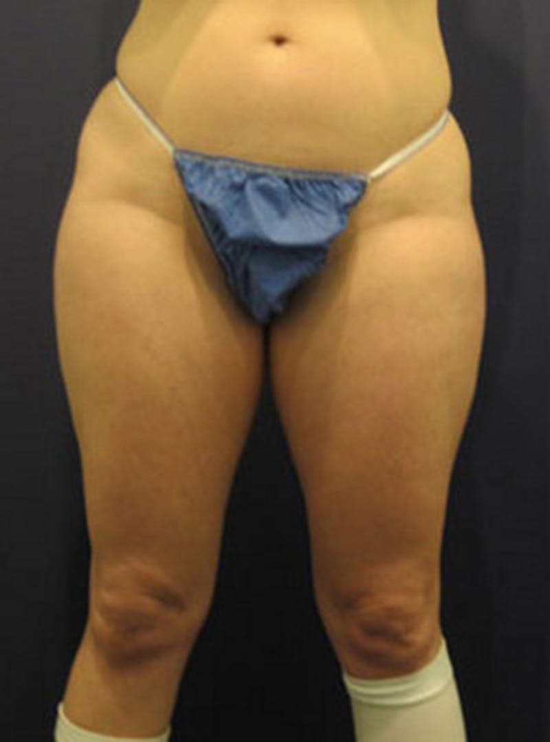 Liposuction Before & After Gallery - Patient 174164435 - Image 1