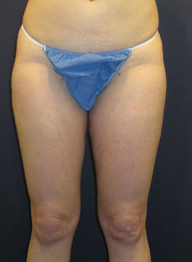 Liposuction Before & After Gallery - Patient 174164435 - Image 2