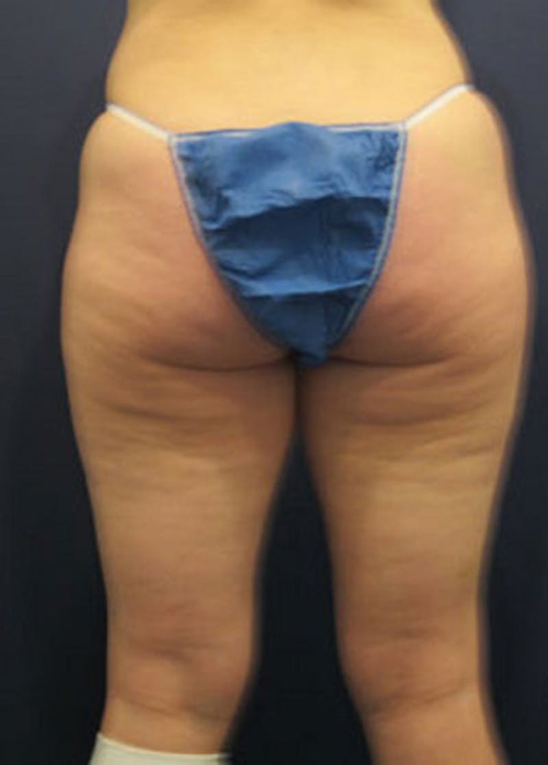 Liposuction Before & After Gallery - Patient 174164435 - Image 3
