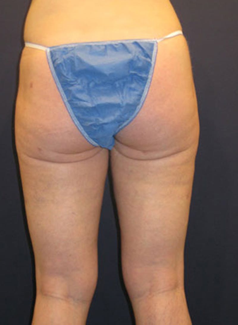 Liposuction Before & After Gallery - Patient 174164435 - Image 4