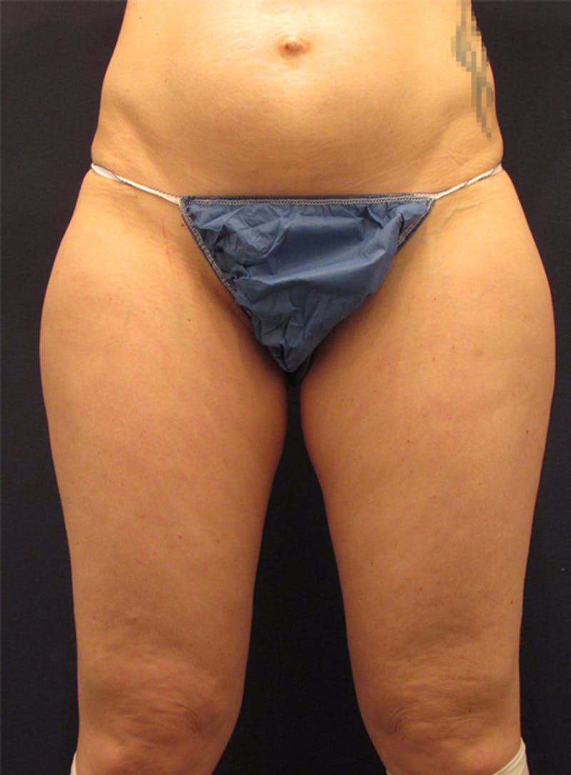 Liposuction Before & After Gallery - Patient 174164438 - Image 1