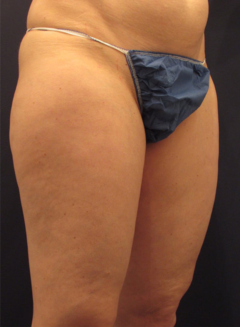 Liposuction Before & After Gallery - Patient 174164438 - Image 3
