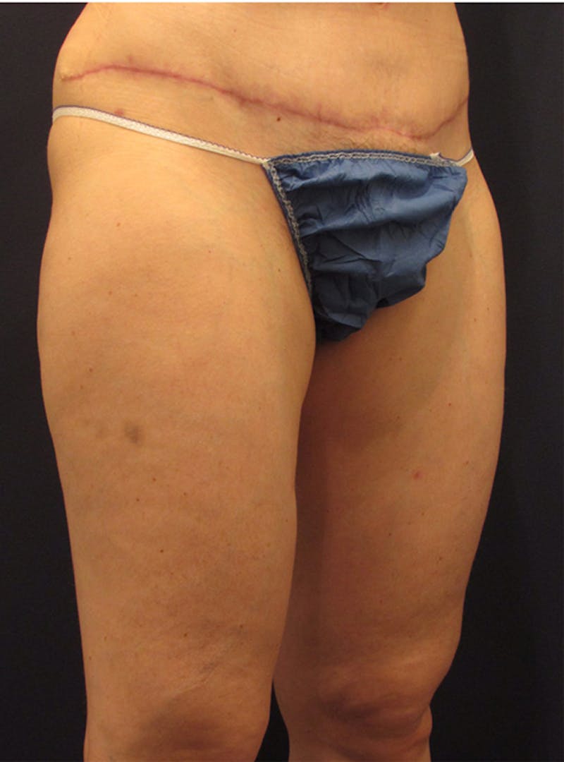 Liposuction Before & After Gallery - Patient 174164438 - Image 4