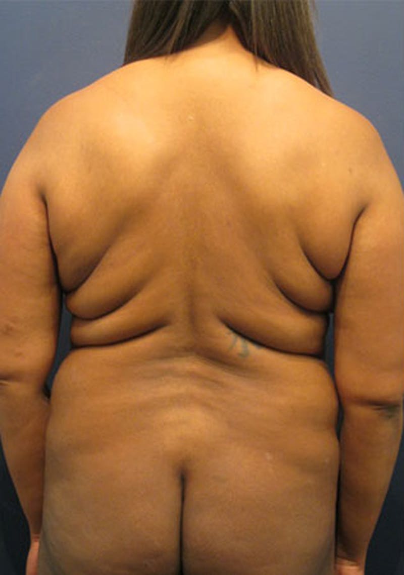 Liposuction Before & After Gallery - Patient 174164442 - Image 1