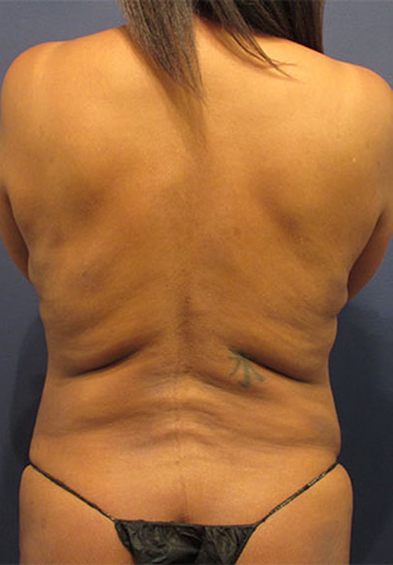 Liposuction Before & After Gallery - Patient 174164442 - Image 2
