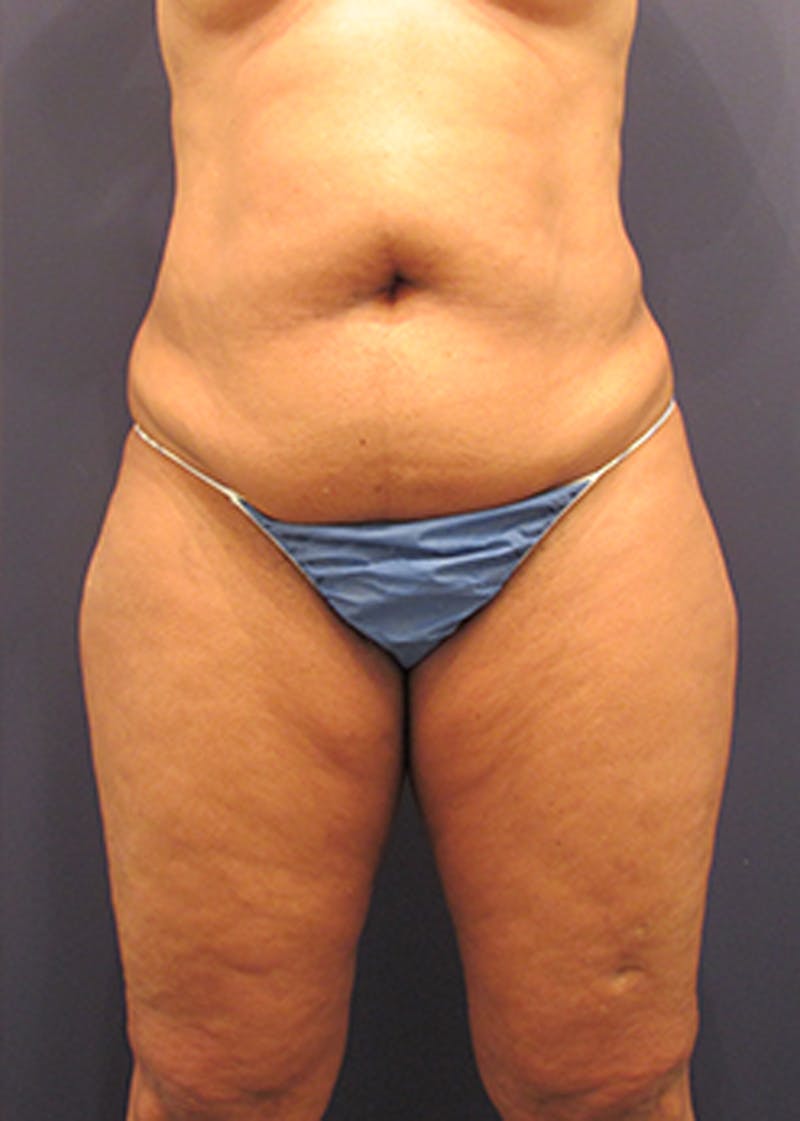 Liposuction Before & After Gallery - Patient 174164449 - Image 1