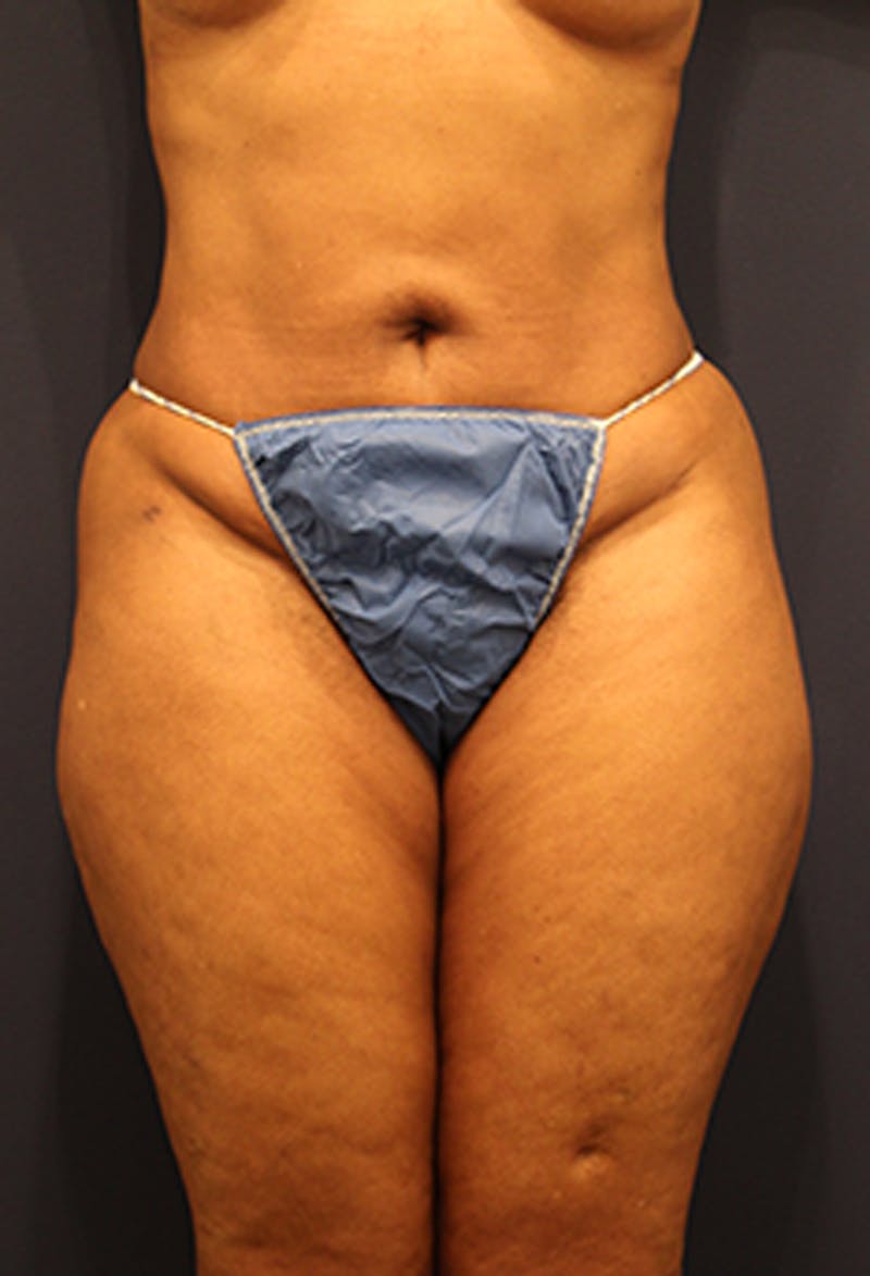 Liposuction Before & After Gallery - Patient 174164449 - Image 2