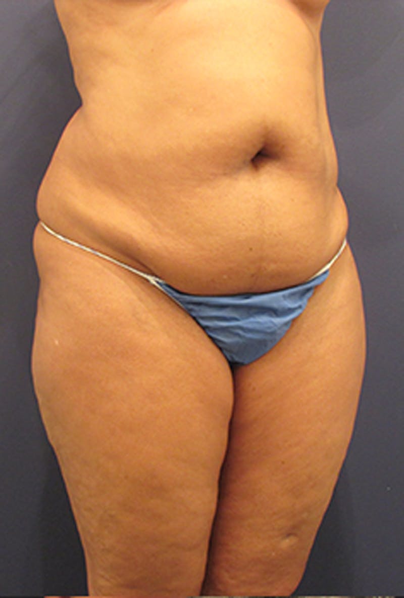 Liposuction Before & After Gallery - Patient 174164449 - Image 3