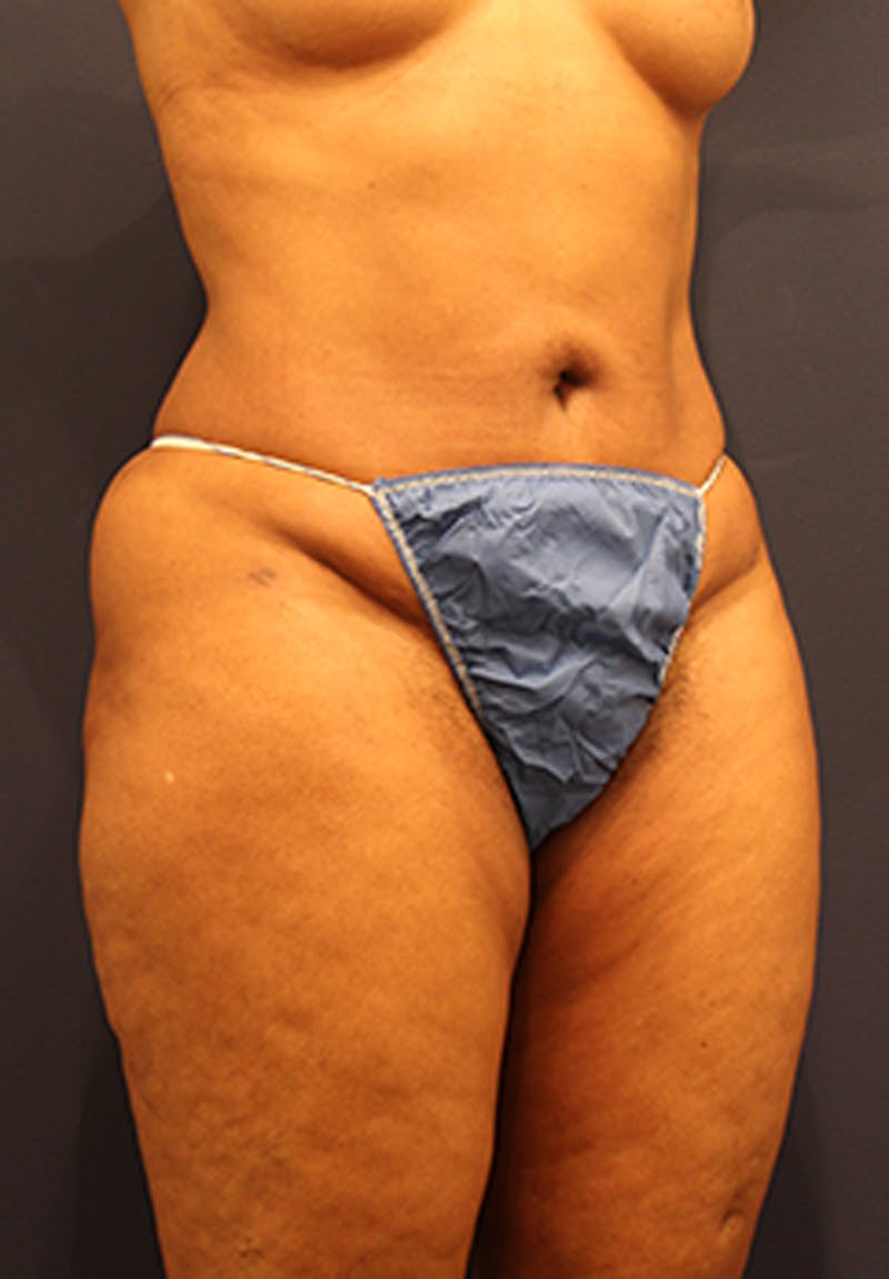 Liposuction Before & After Gallery - Patient 174164449 - Image 4