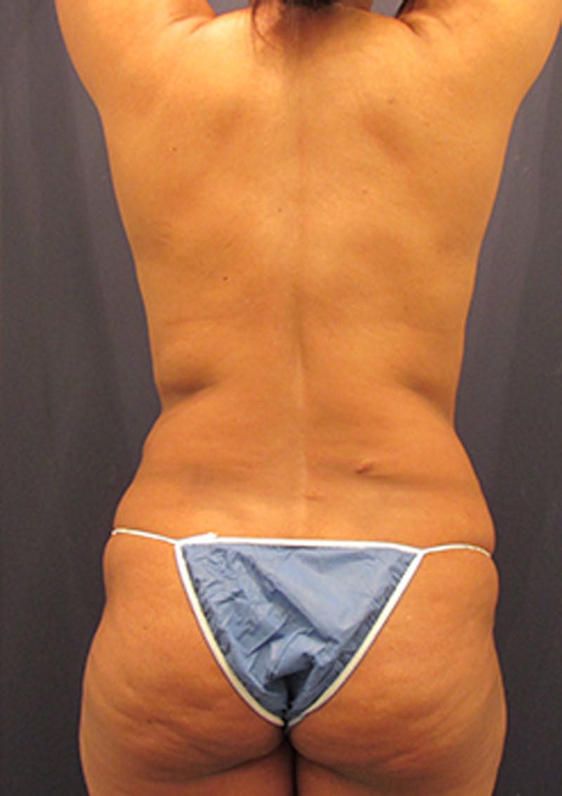 Liposuction Before & After Gallery - Patient 174164449 - Image 5