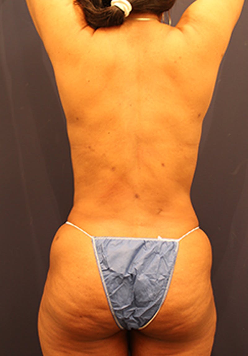 Liposuction Before & After Gallery - Patient 174164449 - Image 6