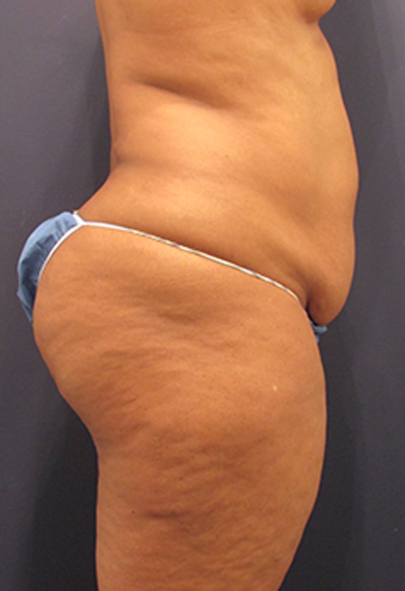 Liposuction Before & After Gallery - Patient 174164449 - Image 7